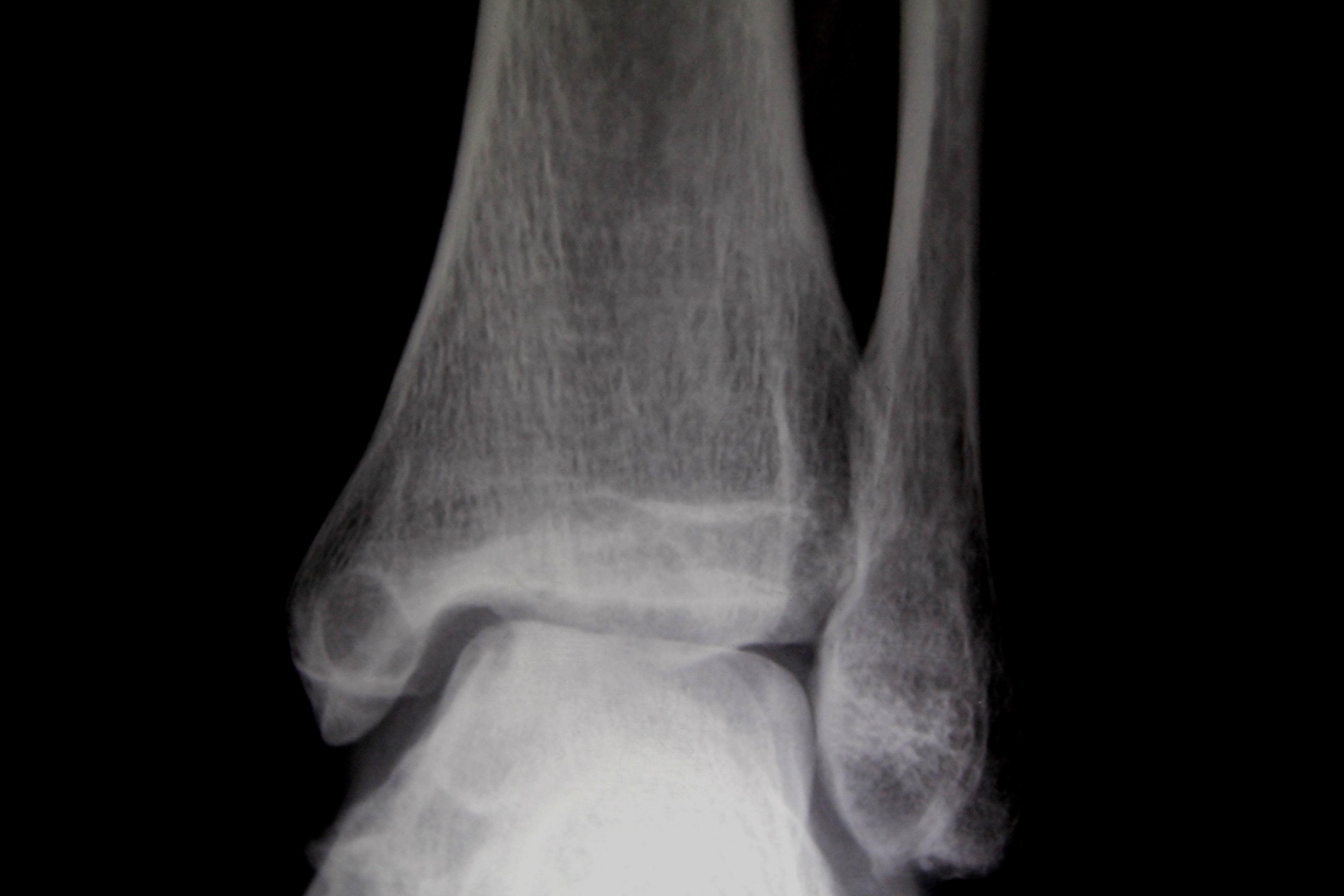 左踝关节肿痛2年