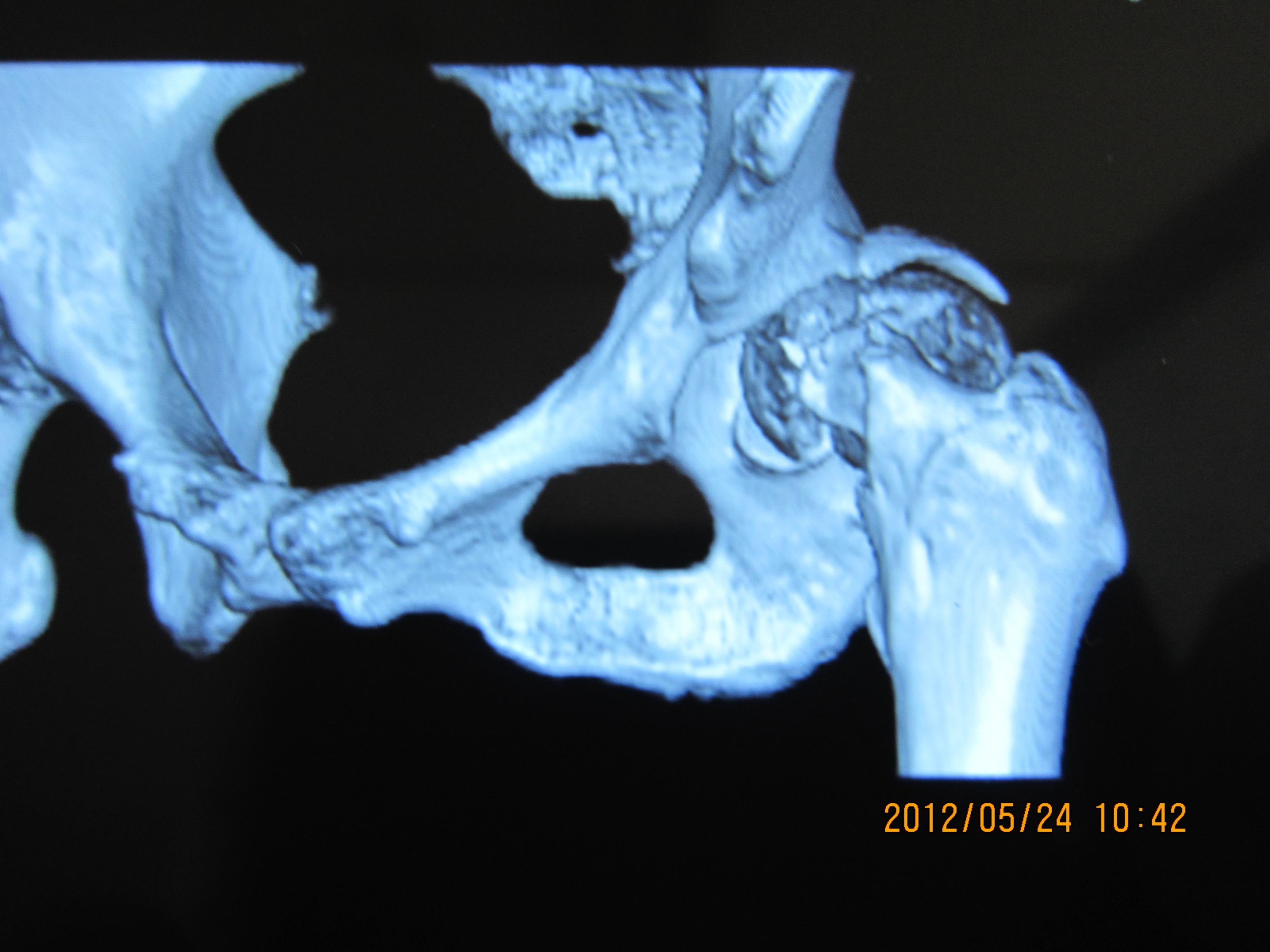 股骨颈骨折一例