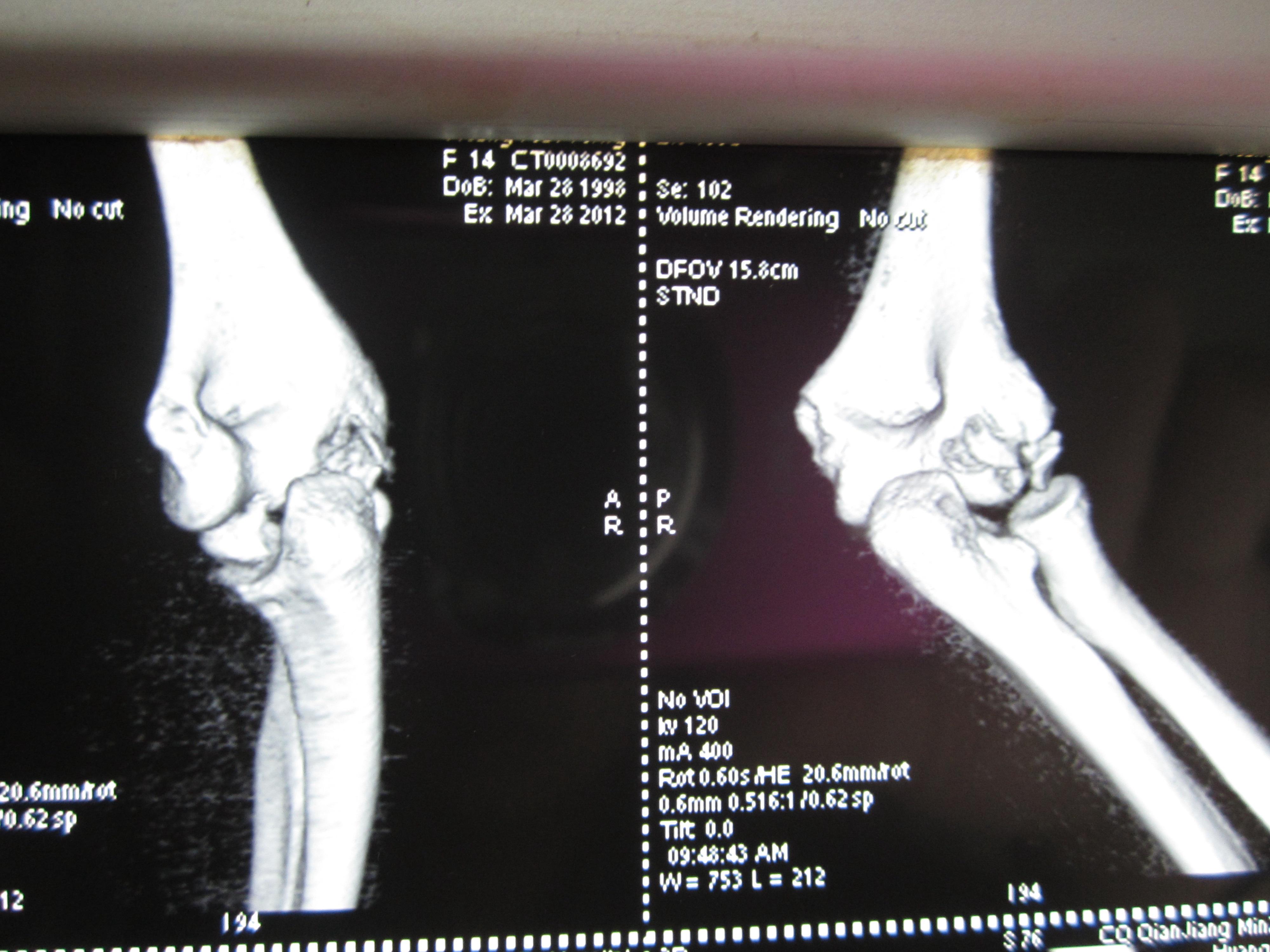 一例复杂的肘关节损伤