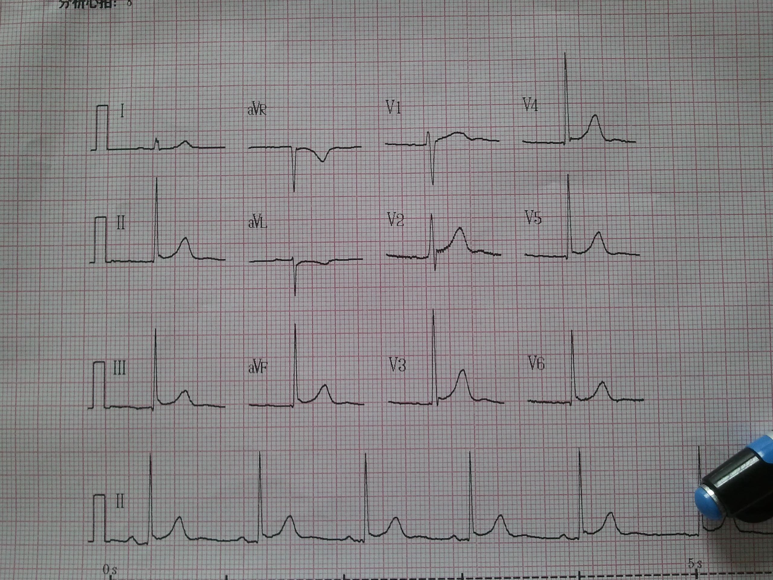 v5--v6可以报轻度st改变啊 - 心电图脑电图专业讨论版 - 爱爱医医学