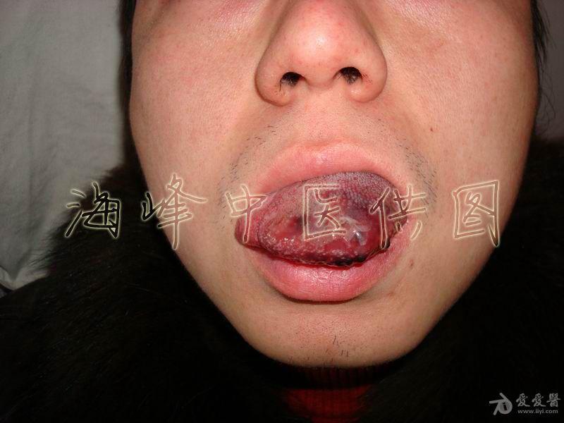 嘴巴里长血管瘤图片图片
