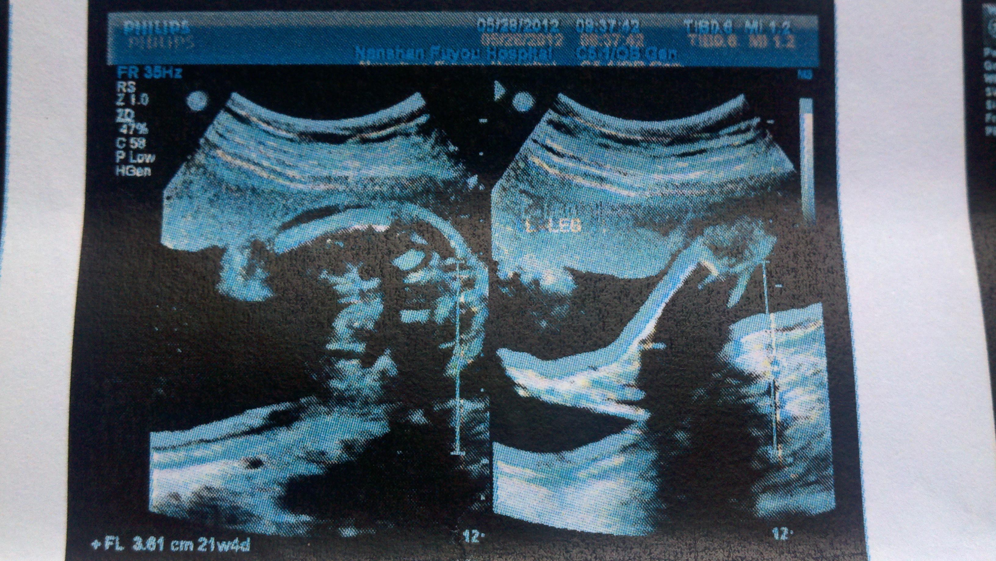 各位专家宝宝还有希望么孕236长骨发育不良内有完整四维超声检查报告