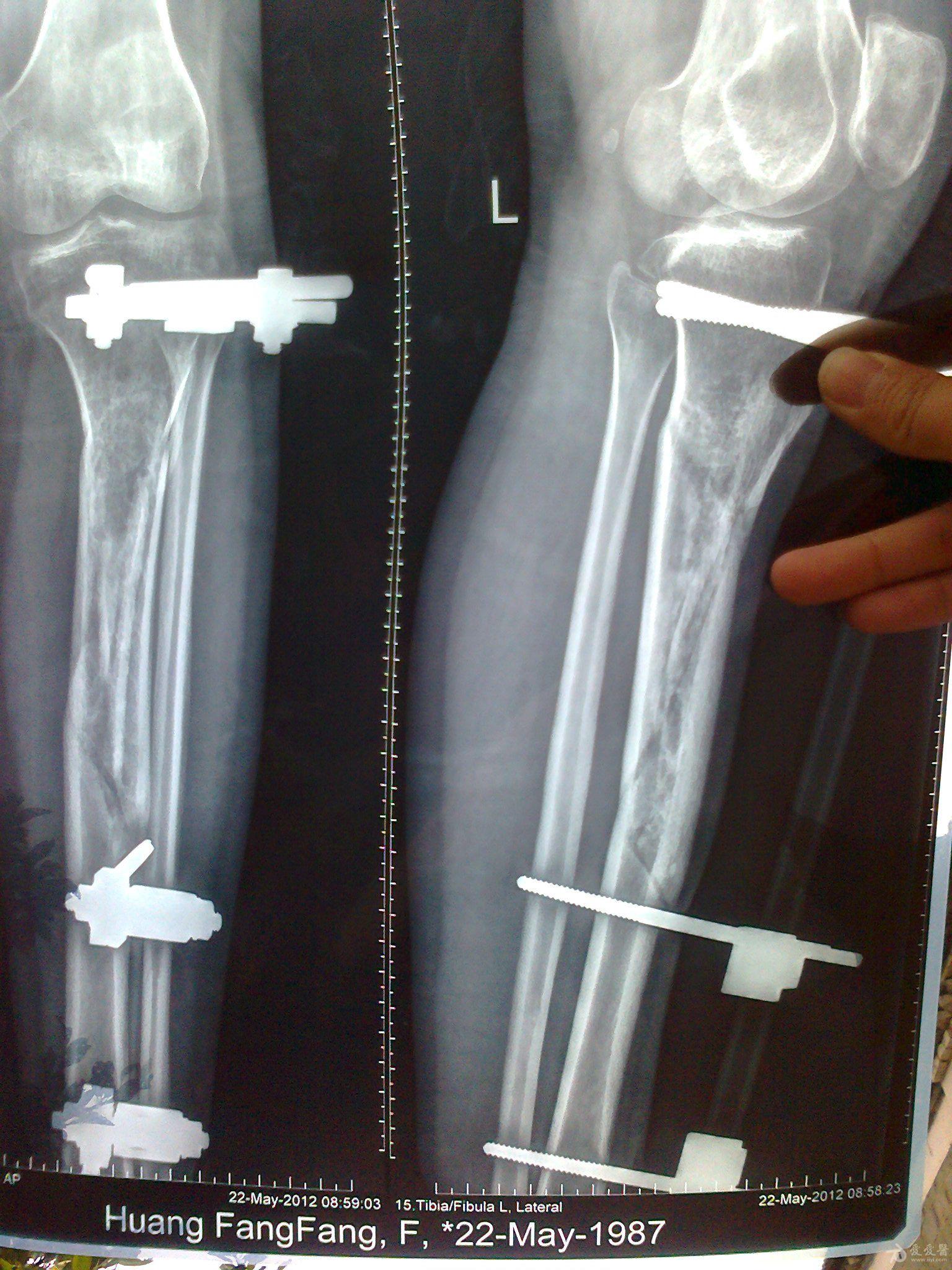 同侧胫骨和股骨粉碎性骨折术后六个月愈合不好