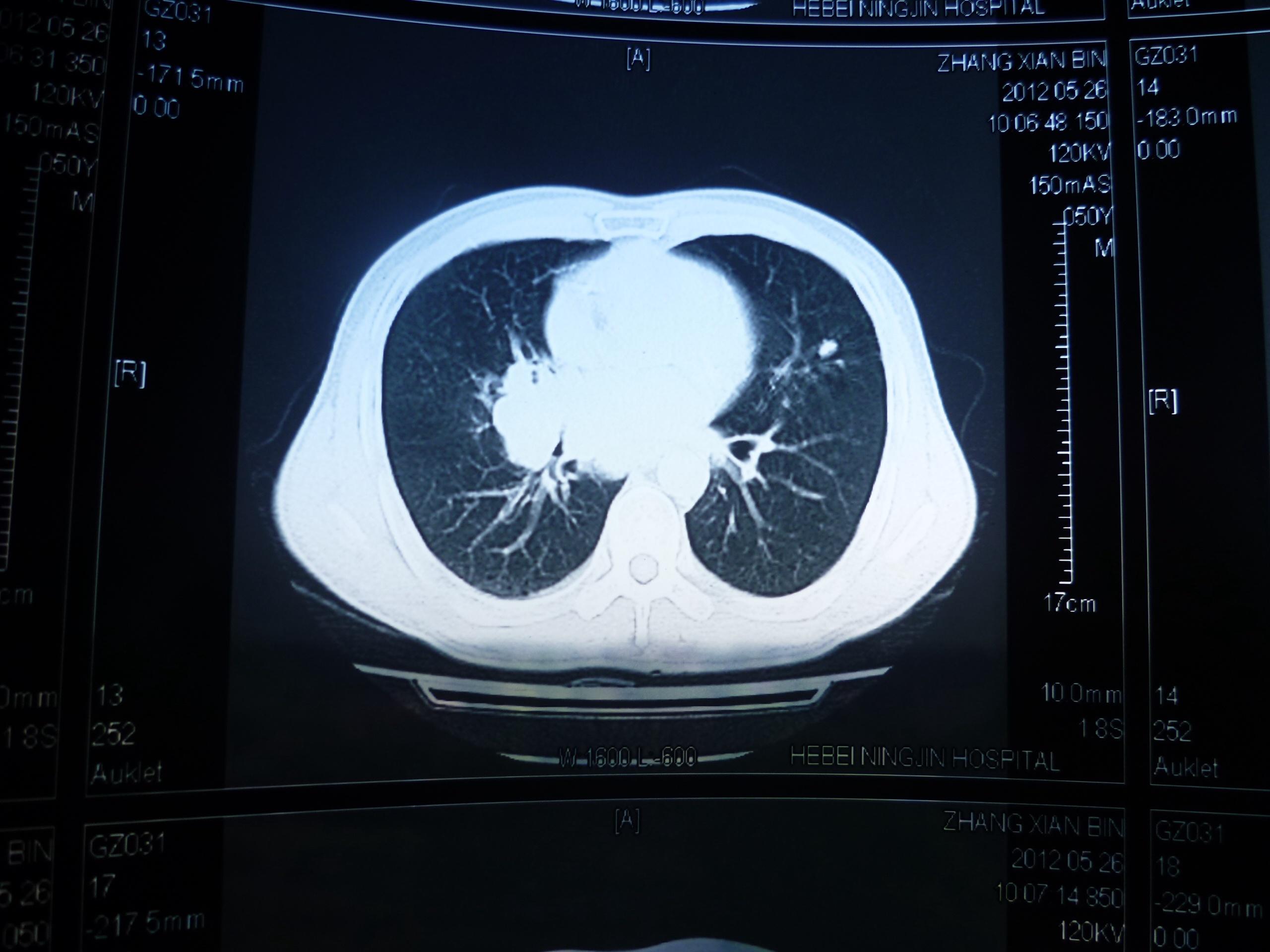 肺癌腦轉移 - 腫瘤醫學專業討論版 - 愛愛醫醫學論壇