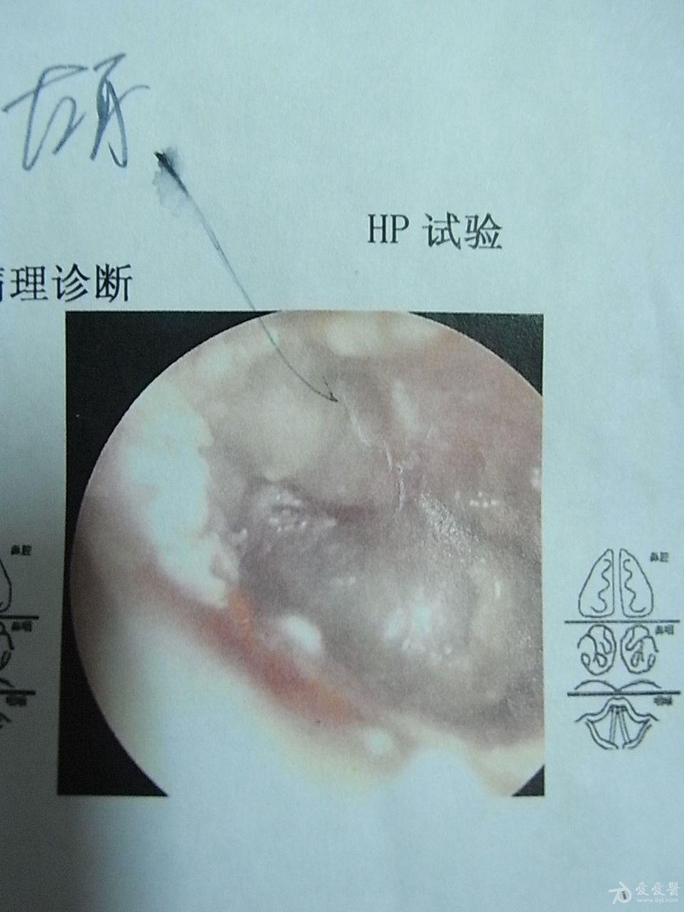 緊急求助中耳乳突炎並膽脂瘤形成