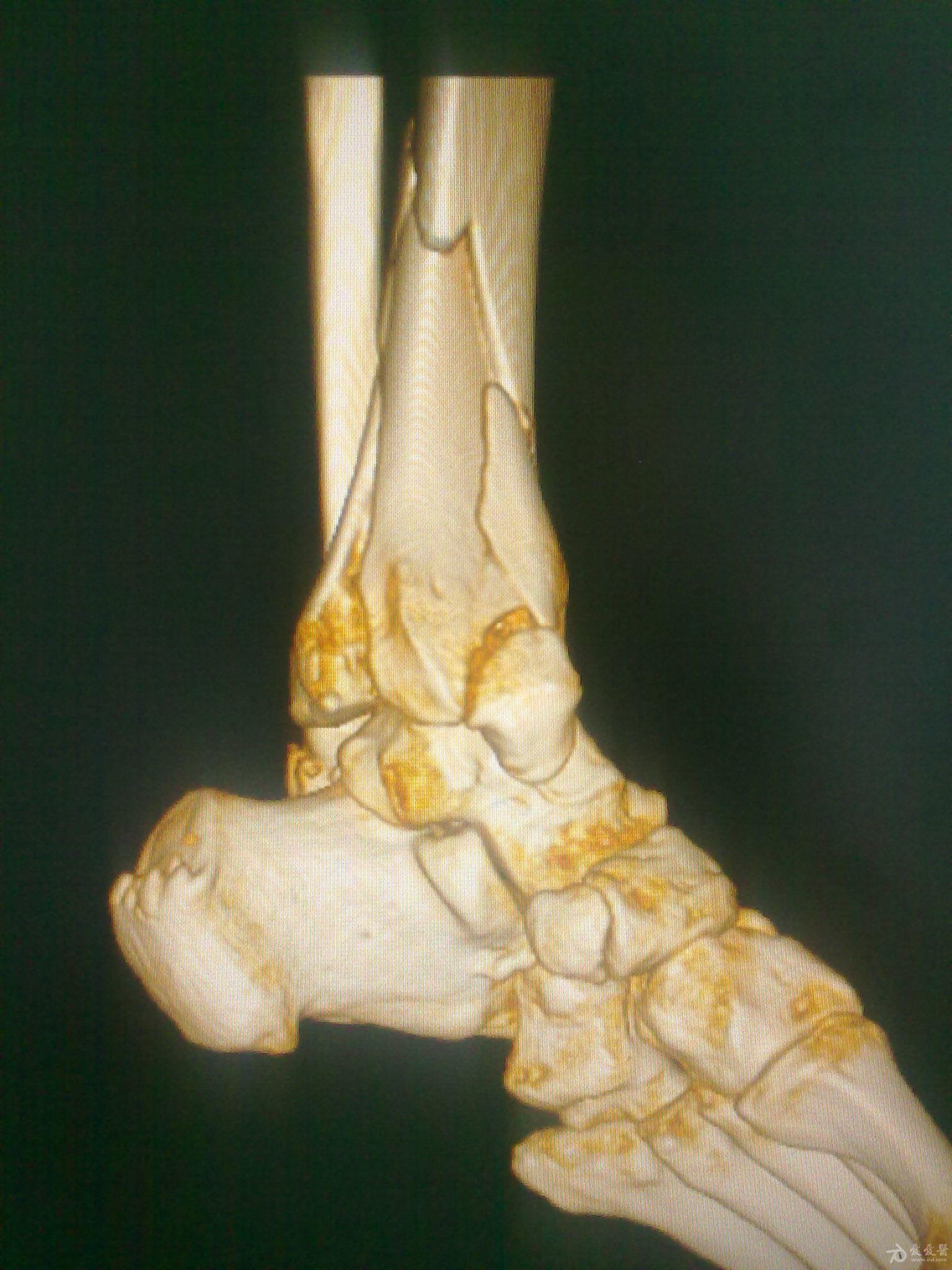 左胫骨pilon骨折