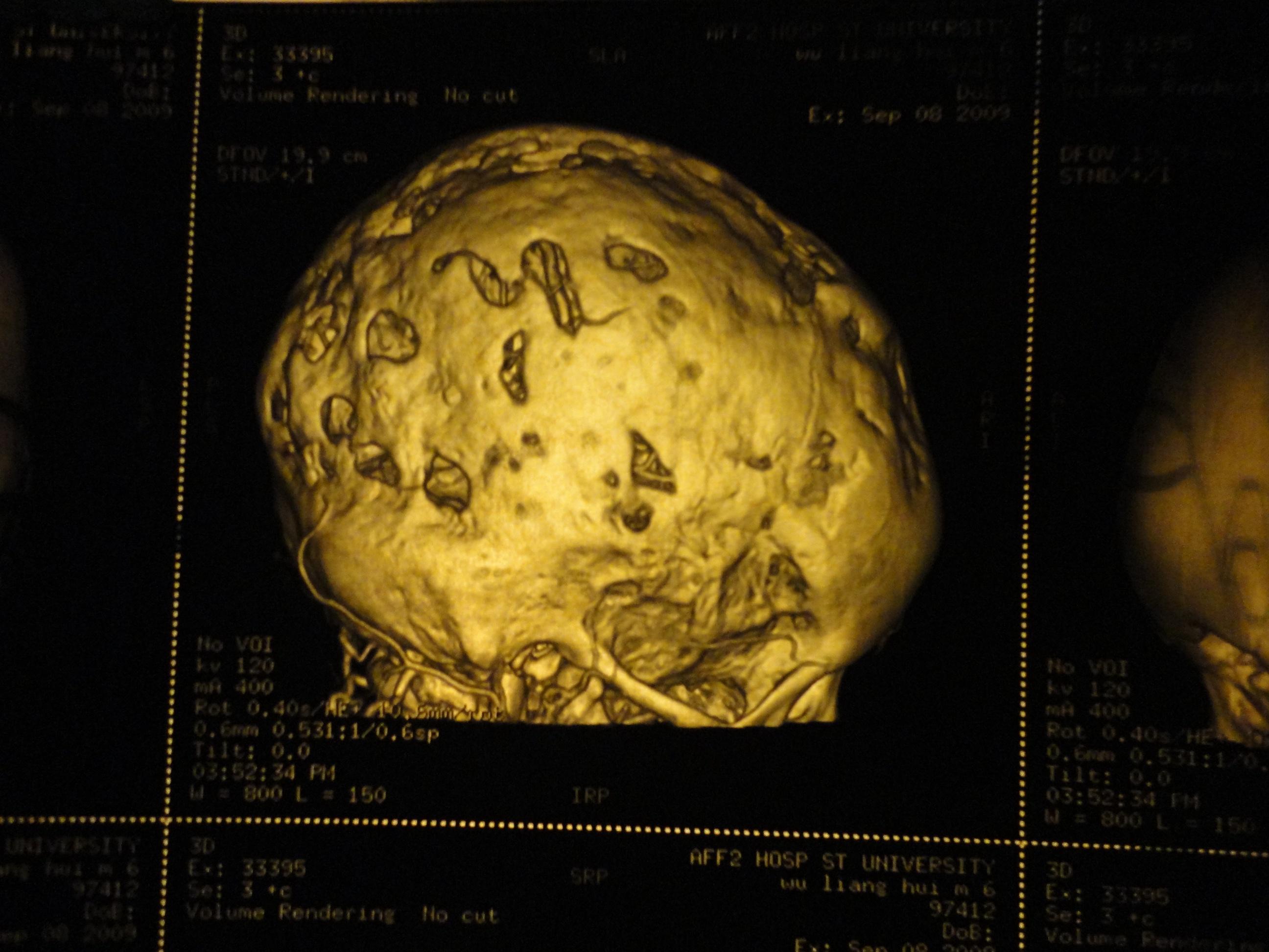 见过这样的头颅ct吗请爱医人分析