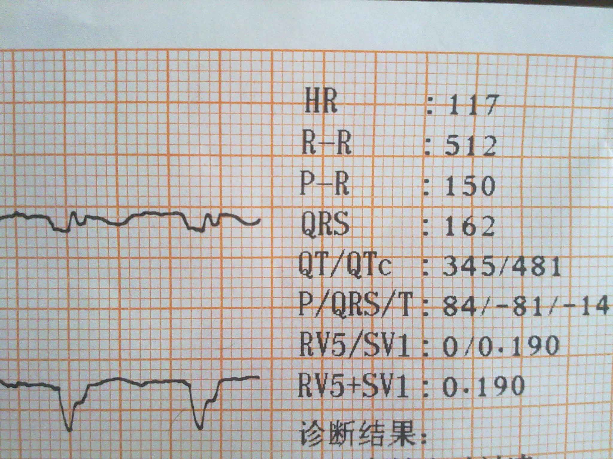 請求版主看此份心電圖