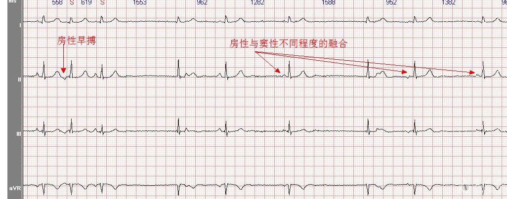 心電圖學習20120602(有獎讀圖第九期)截止到7月1日