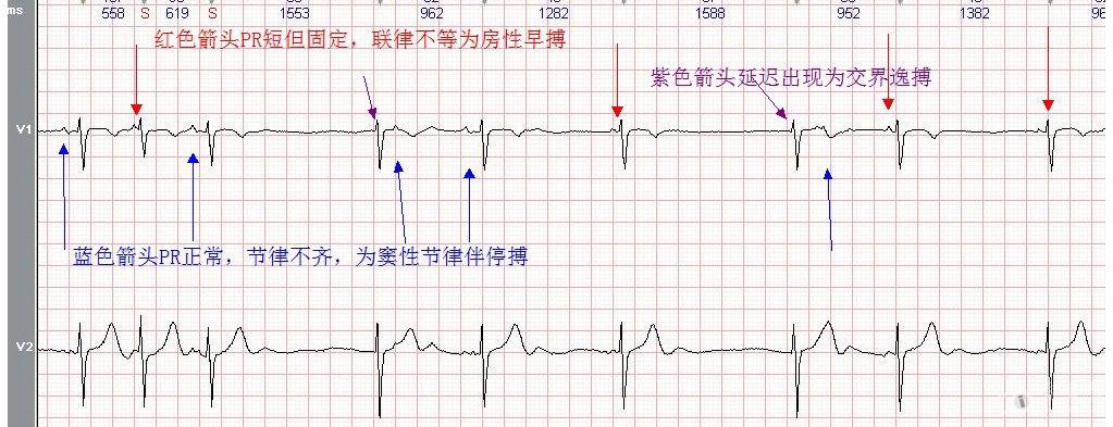 心電圖學習20120602(有獎讀圖第九期)截止到7月1日