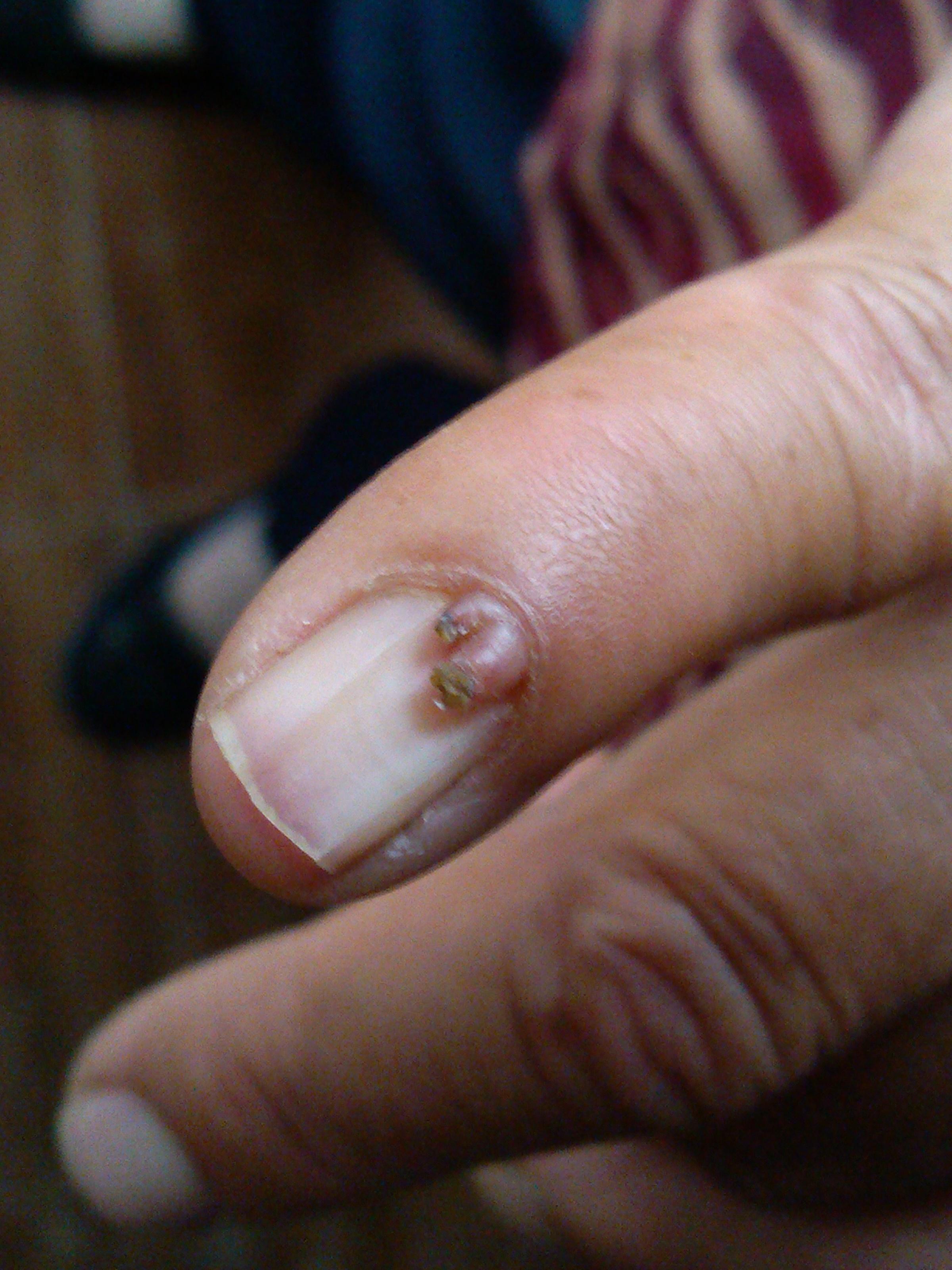 最近见的一例手指甲赘生物