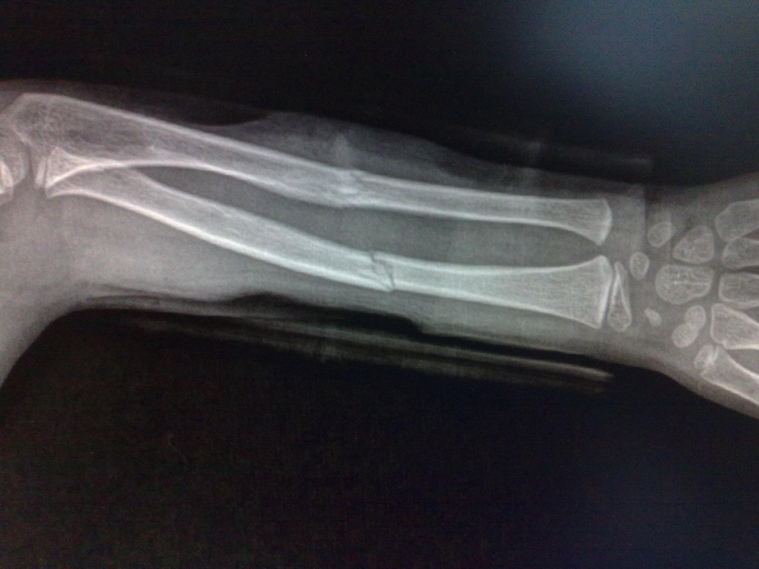 手臂尺骨骨折错位图片图片