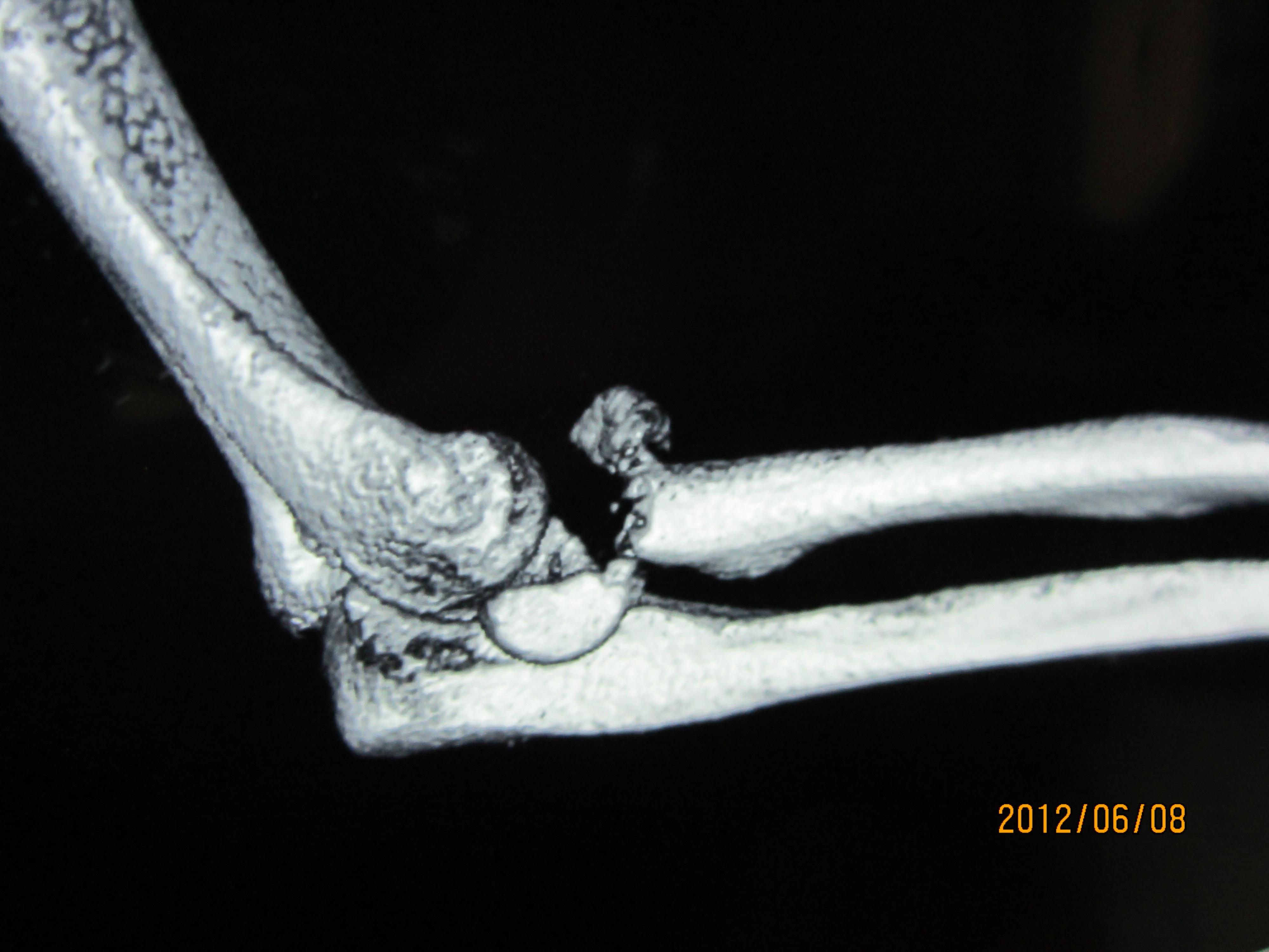 右肘關節脫位合併饒骨小頭粉碎性骨折的治療方法