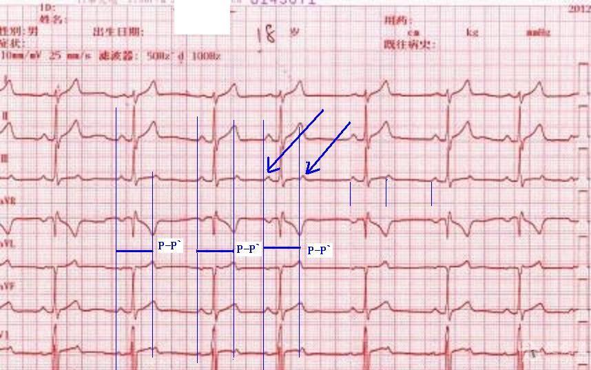 该常规体检心电图该如何诊断?