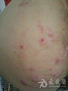 臀部是什么皮肤病