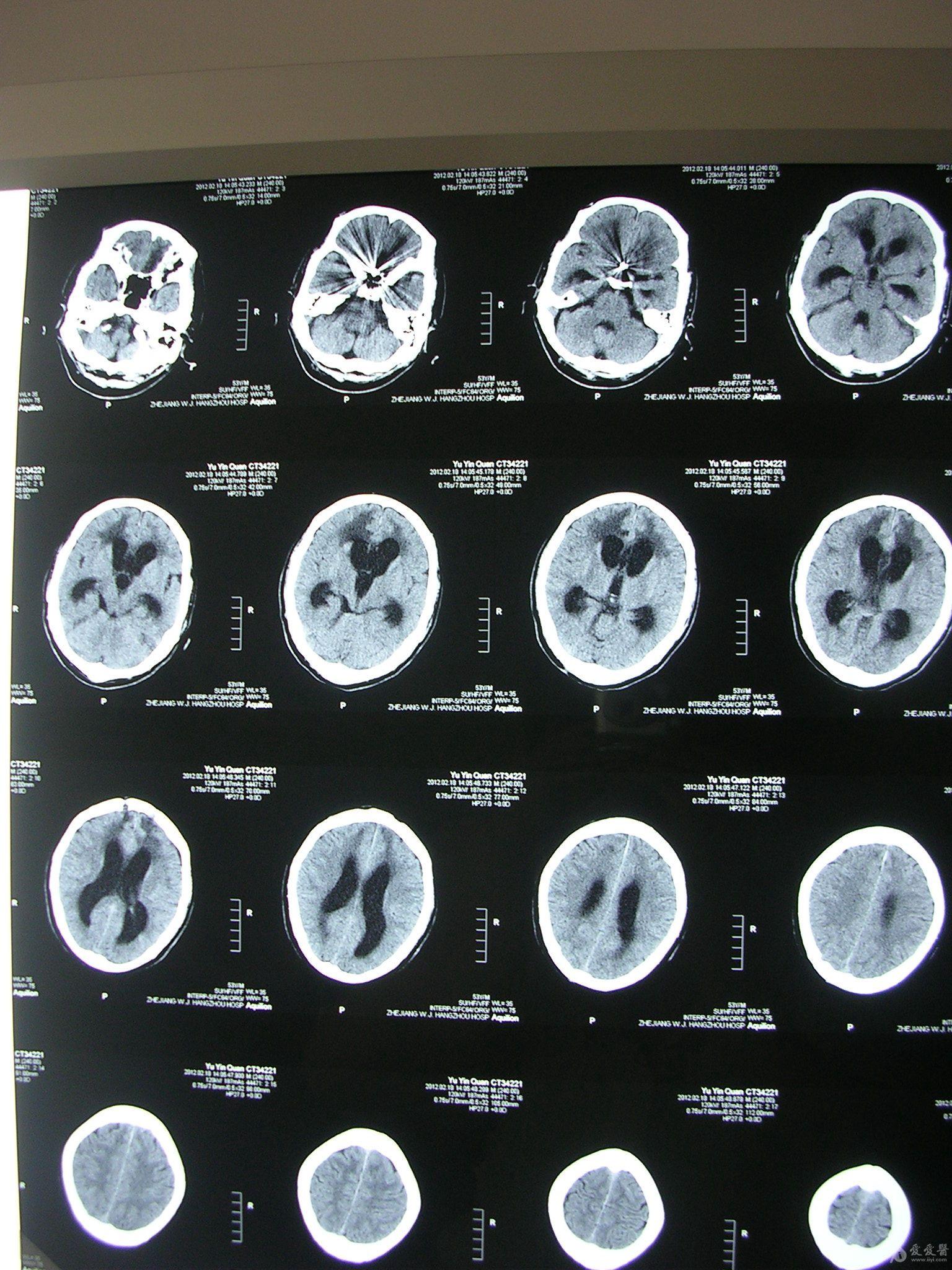 该脑积水病例手术指征明确明确吗