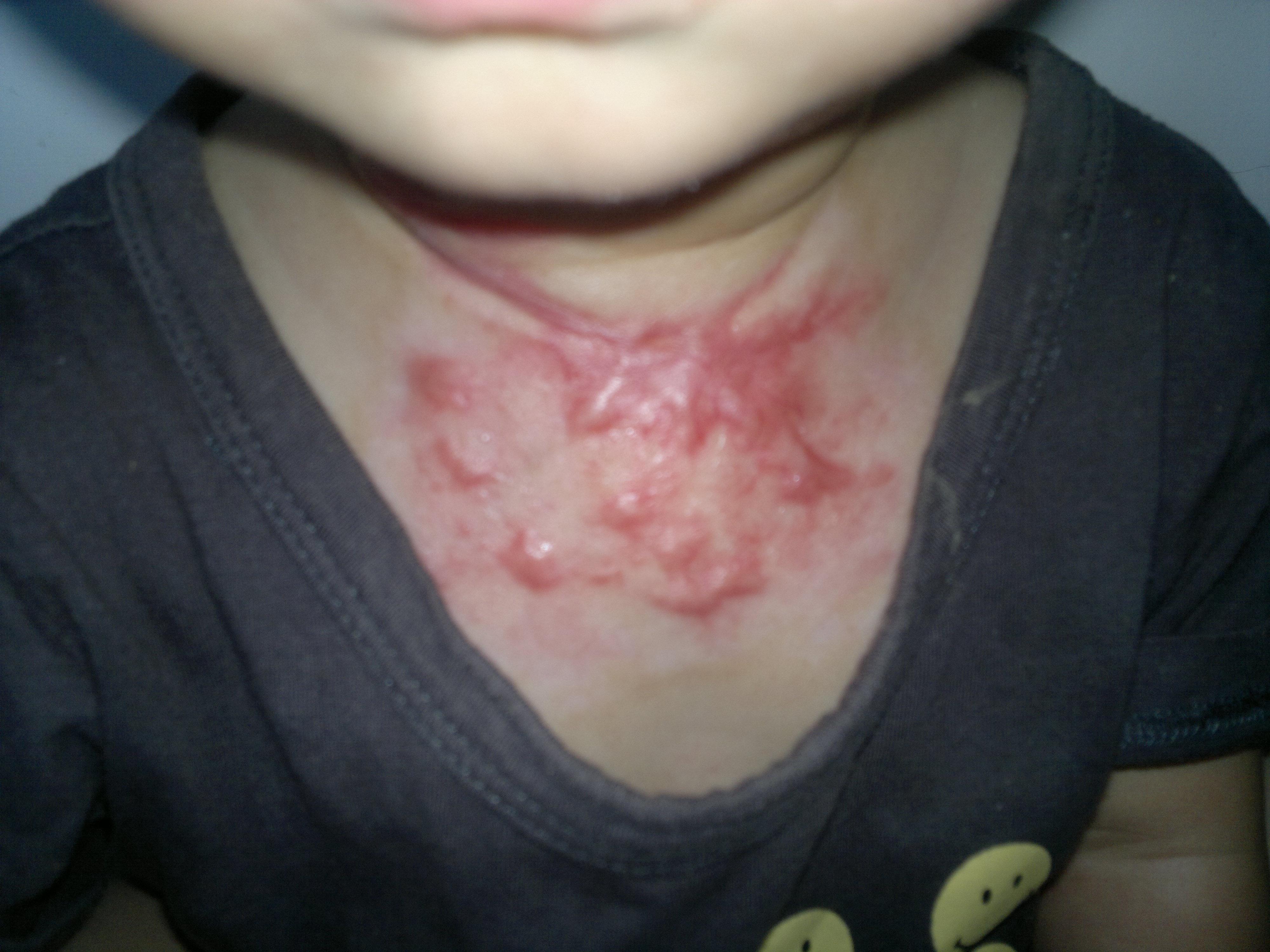 疤痕多久才会发白 12061213000cb829b019176710.jpg