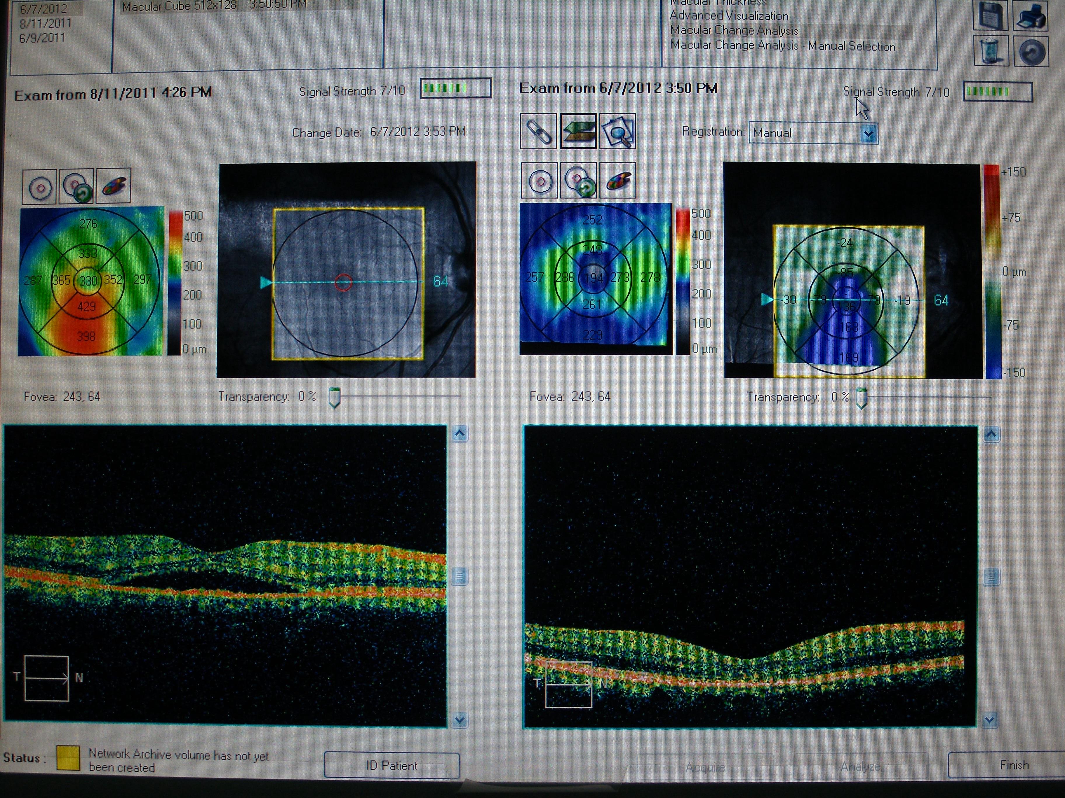 局限性浆液性视网膜脱离治疗前后oct对比图