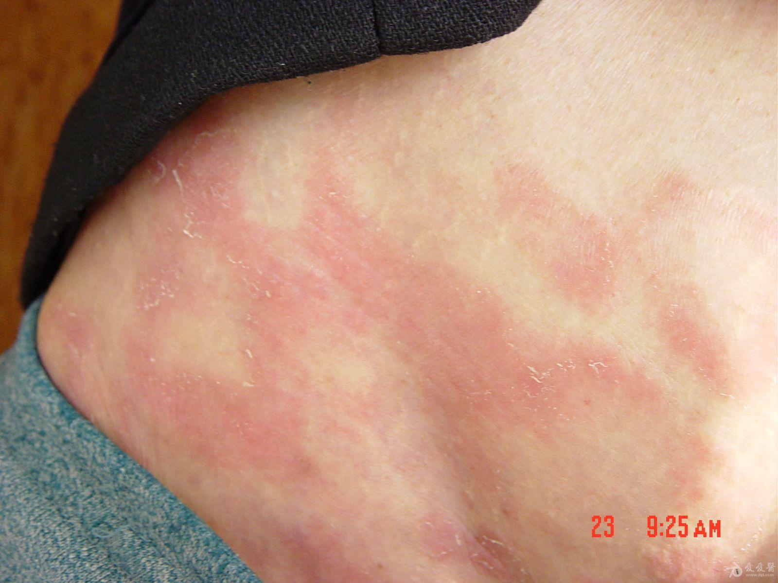 私人珍藏蕈样肉牙肿图片