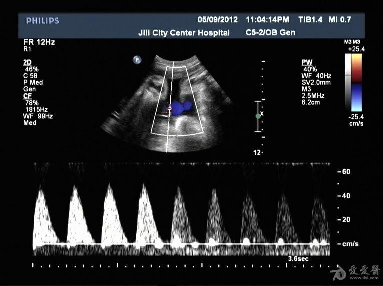 胎儿脐动脉血流频谱呈单峰有什么特别的意义吗