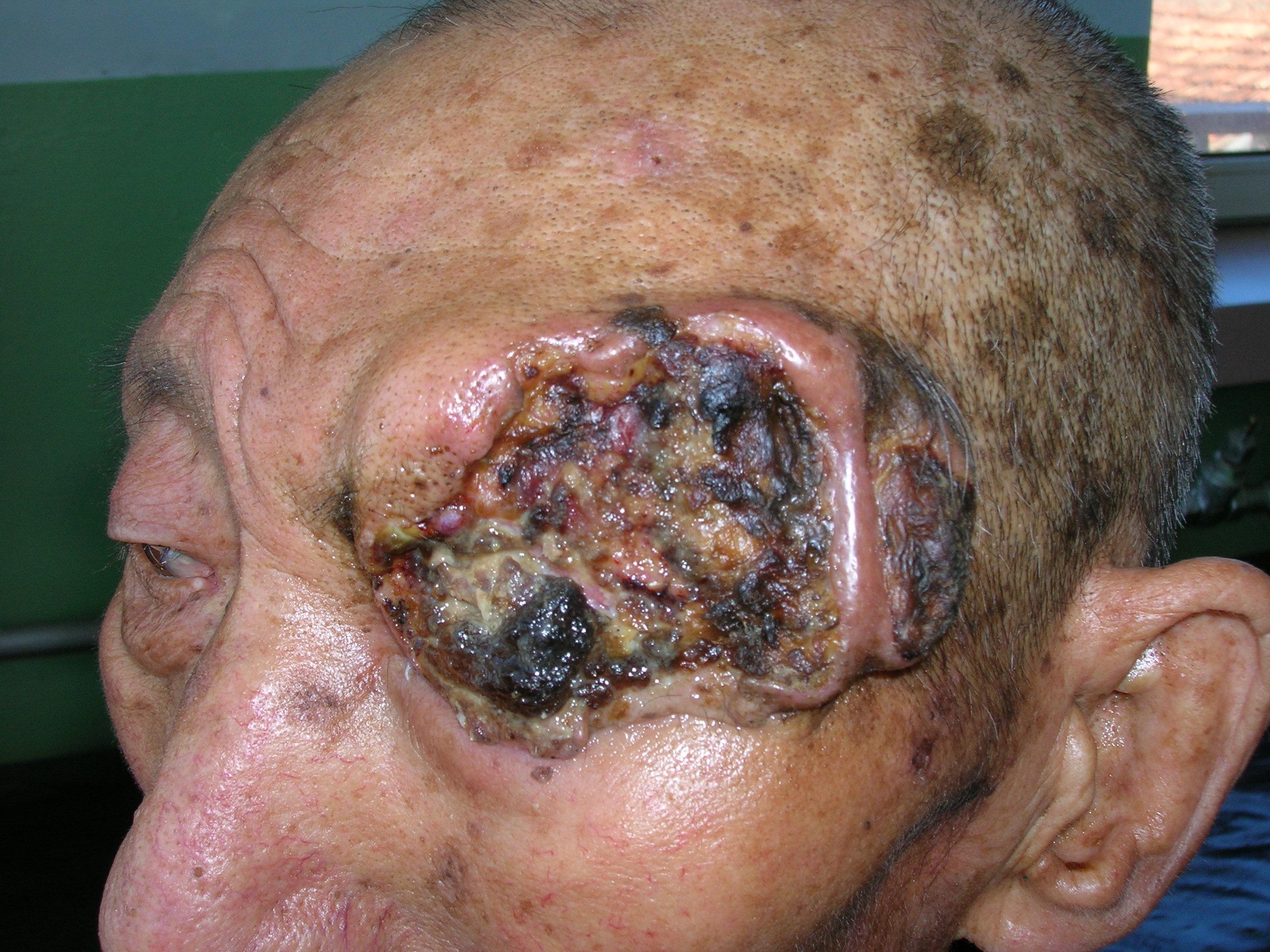 皮肤癌初期前期图片