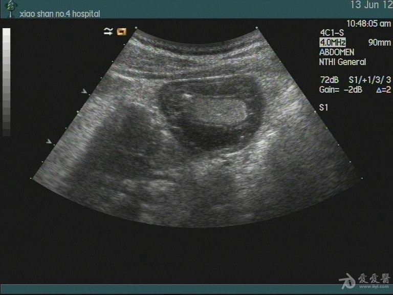 急性胃炎声像图