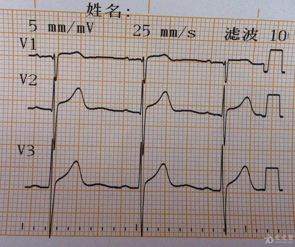 [心電圖分析] v1,v2小q波