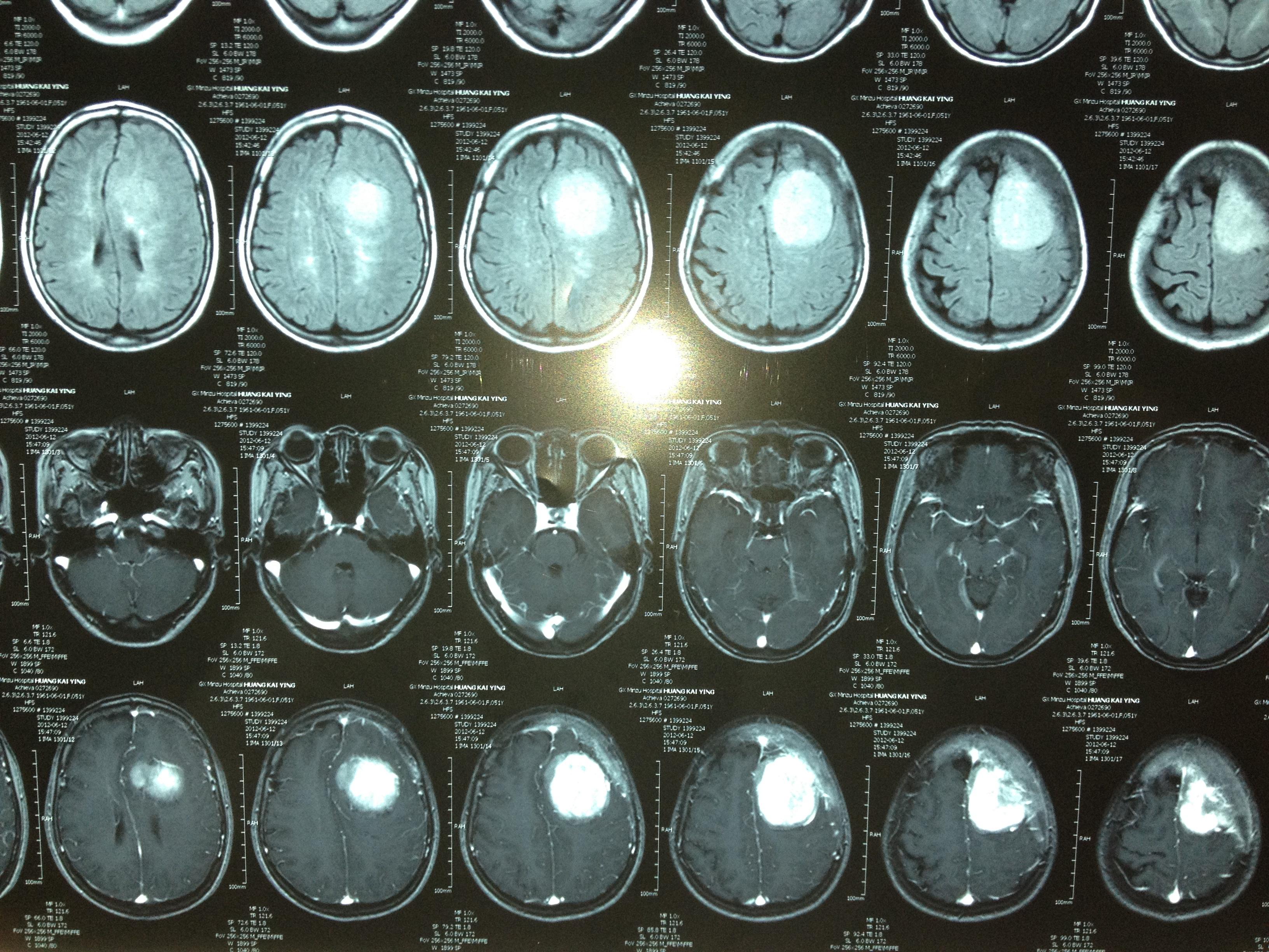 脑膜瘤MRI图片