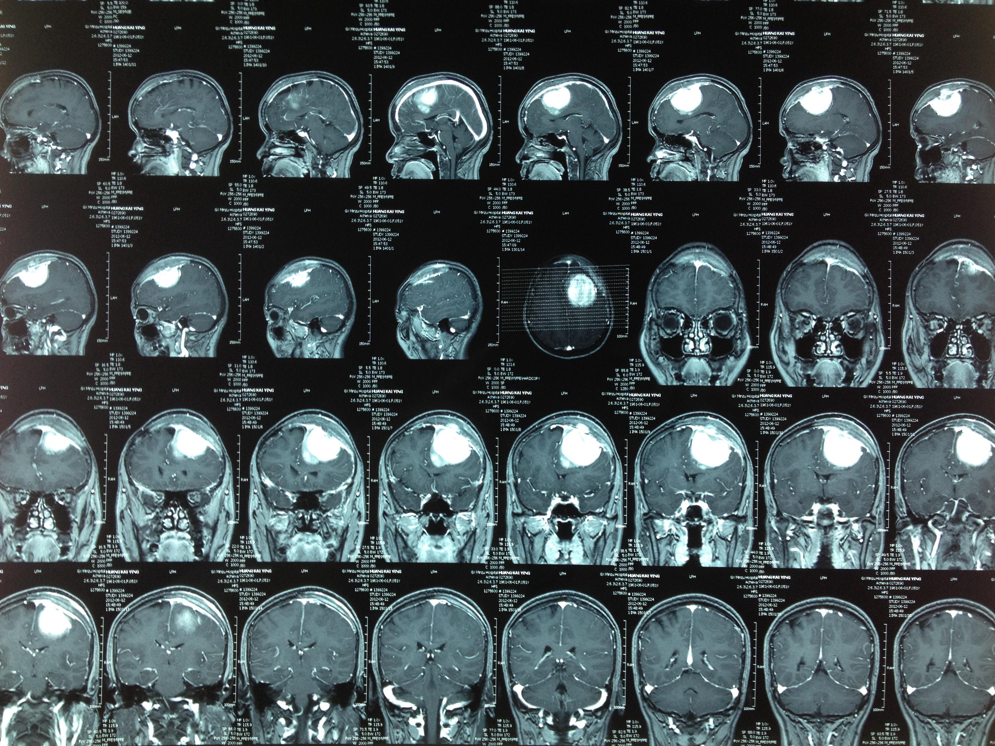 一例幕上脑膜瘤的手术探讨