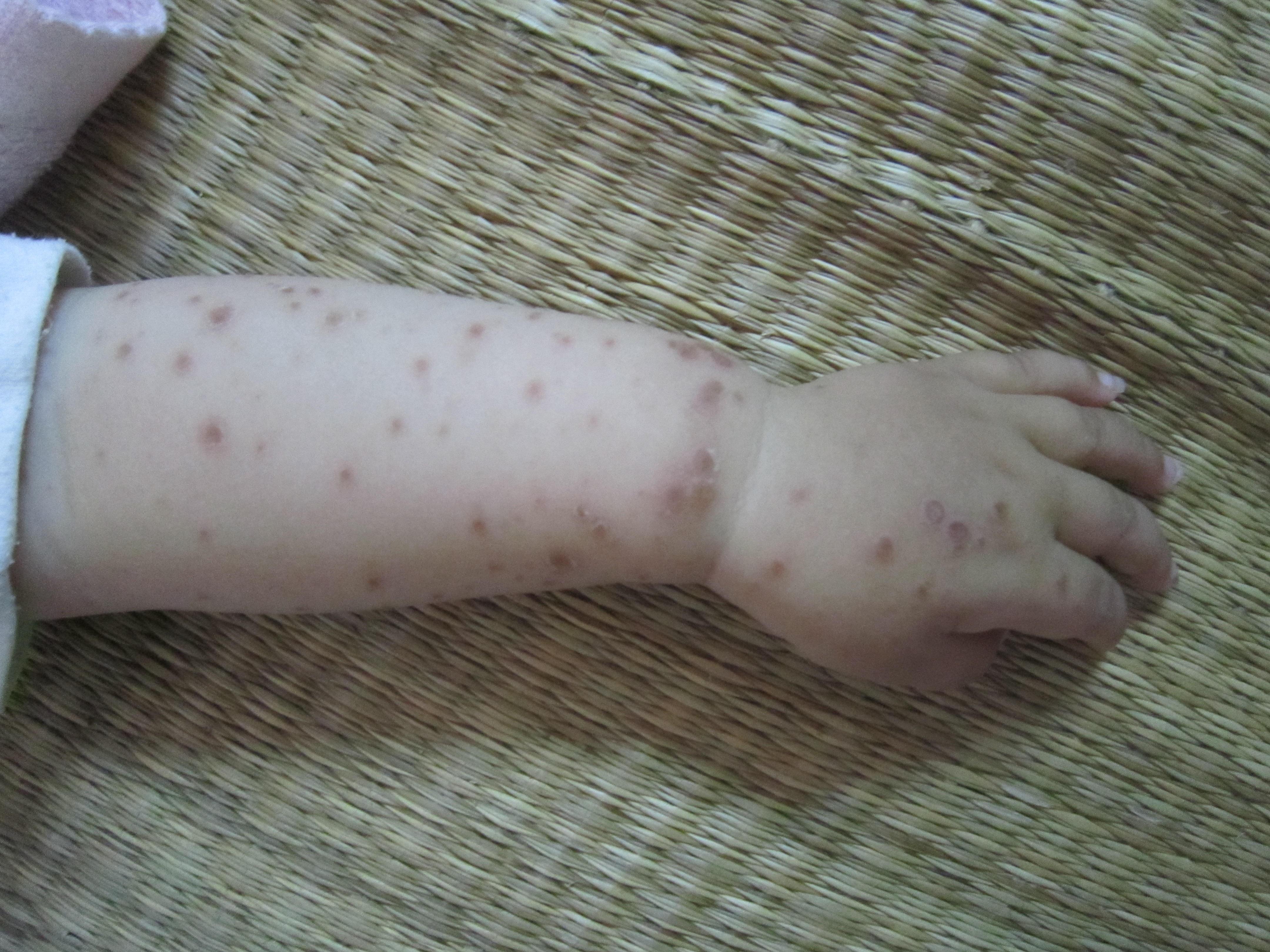 儿童感染性皮疹图片