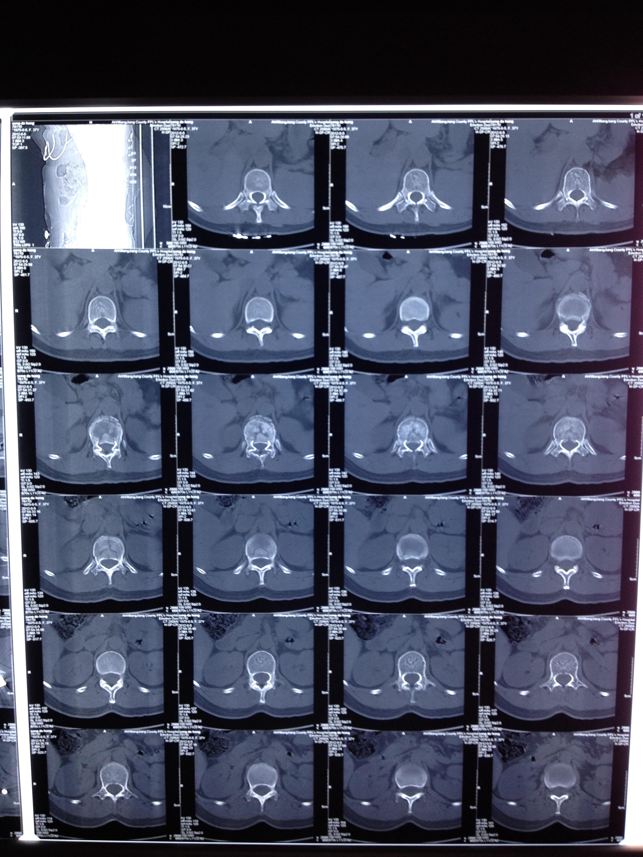 t12椎体爆裂性骨折伴不全瘫没有减压看效果