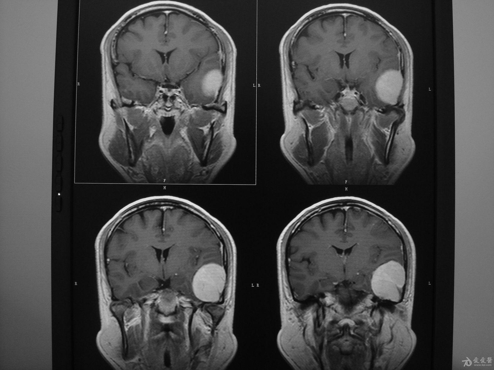 论坛 69 ★临床检查区 69 医学影像学讨论版 69 颅脑mri平扫