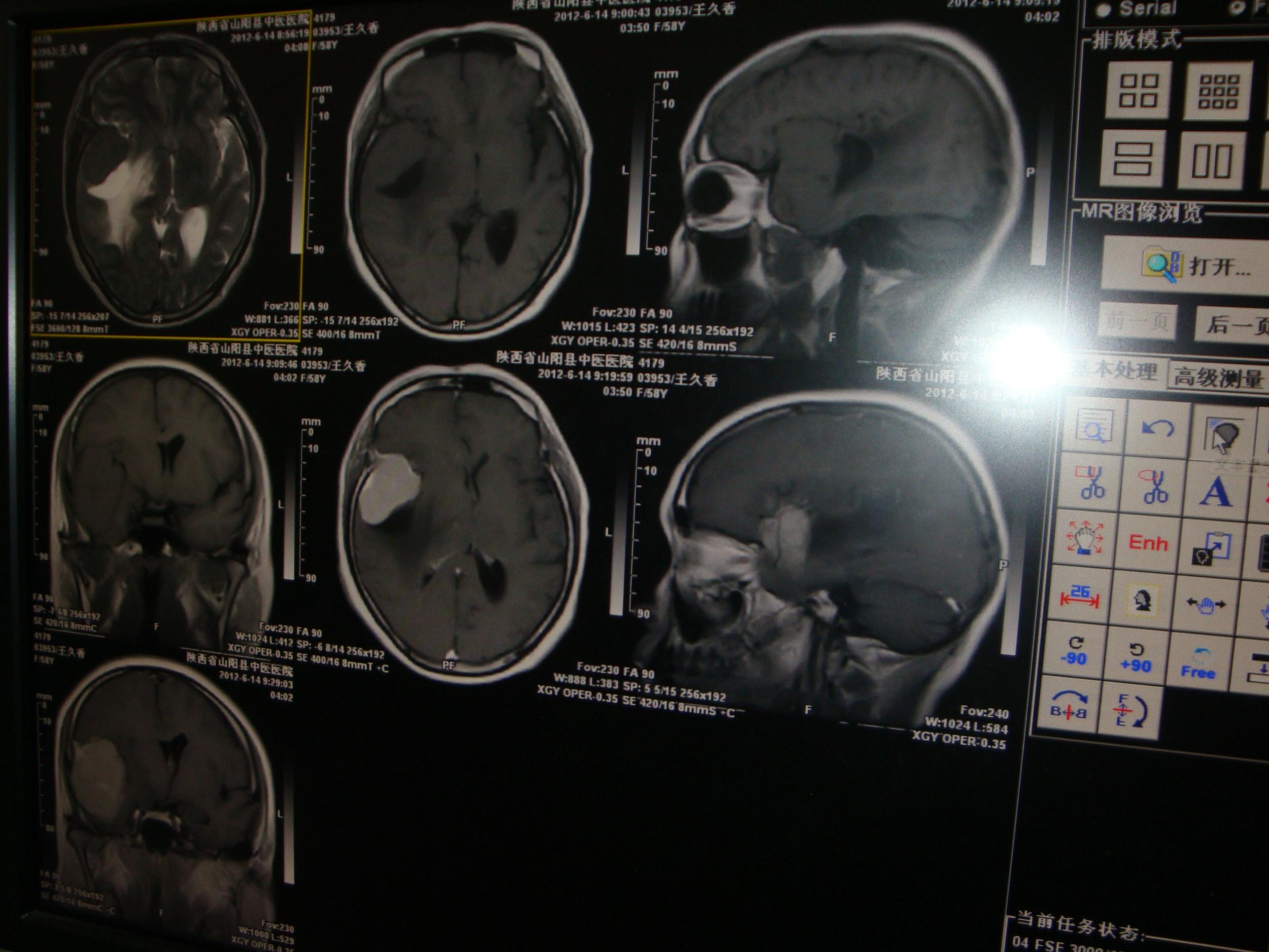 病例讨论右侧蝶骨嵴脑膜瘤