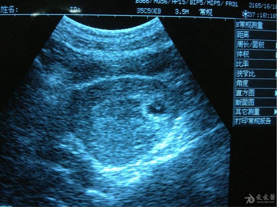 宫角妊娠声像图表现图片