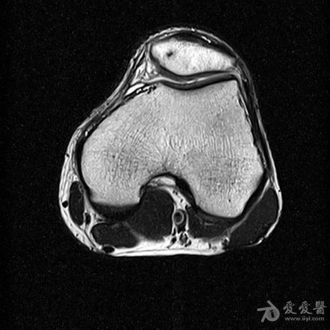 mri膝关节特殊病例分析