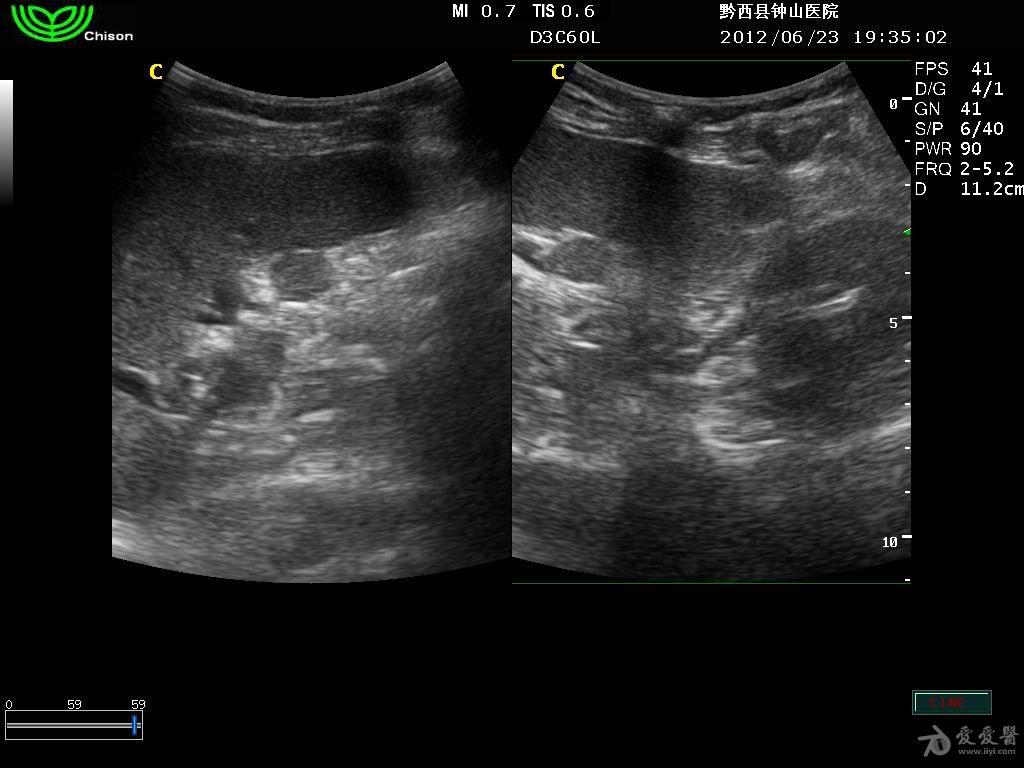 副脾- 超声医学讨论版 - 爱爱医医学论坛