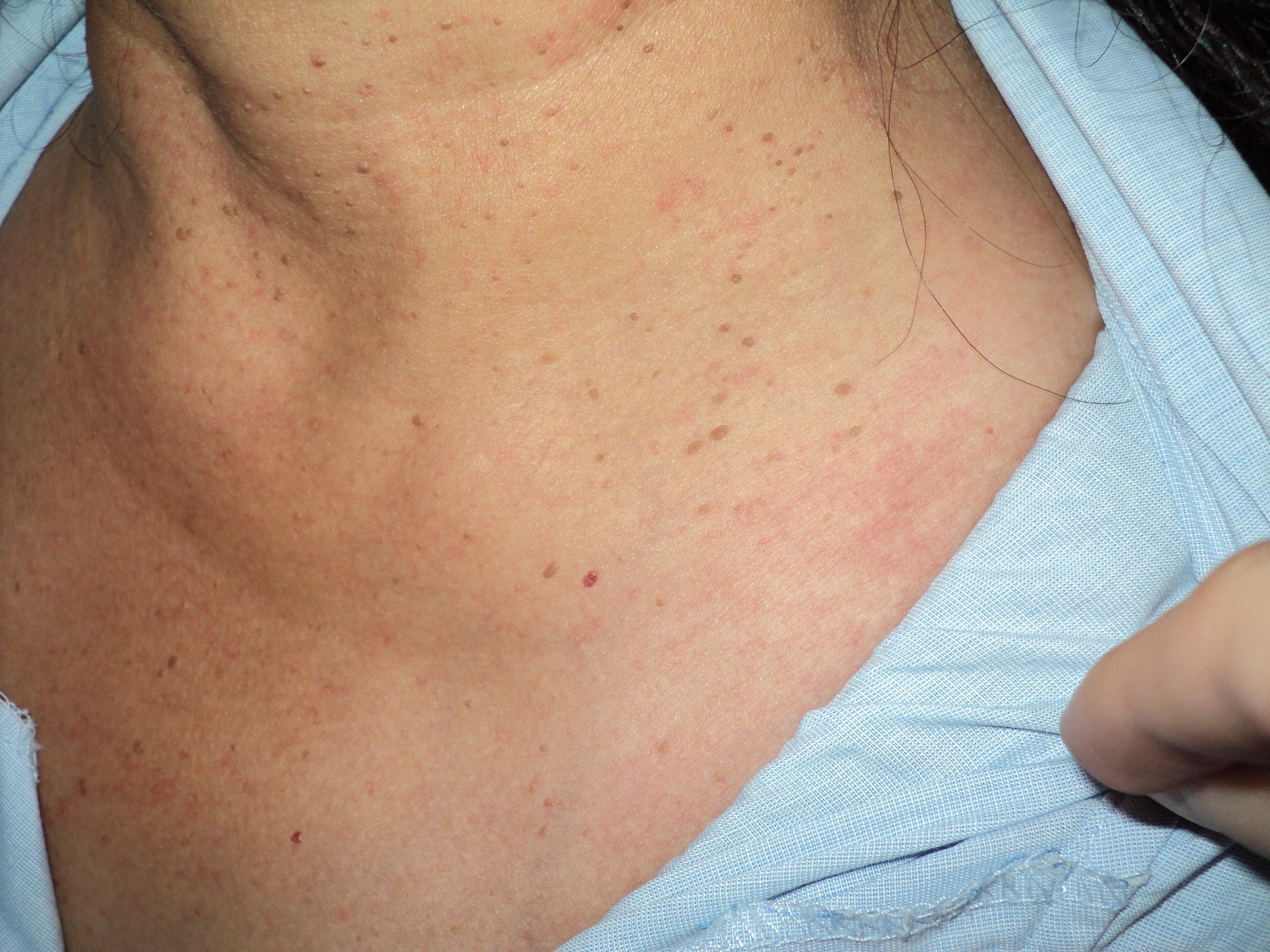 请教该顽固荨麻疹有什么好的办法治疗