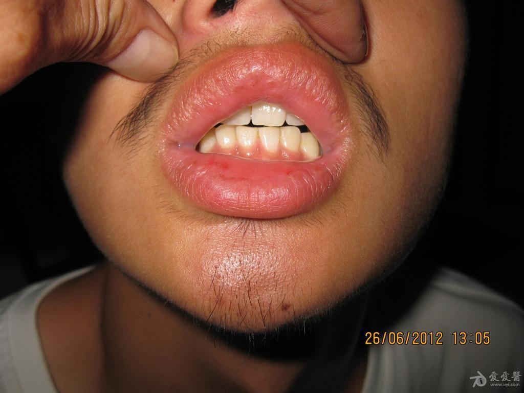 牙龈皮脂腺异位图片图片
