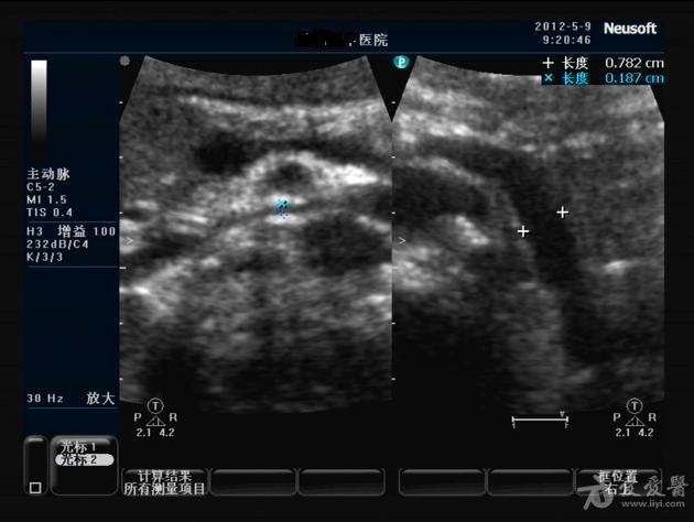 胡桃夹综合征超声图片