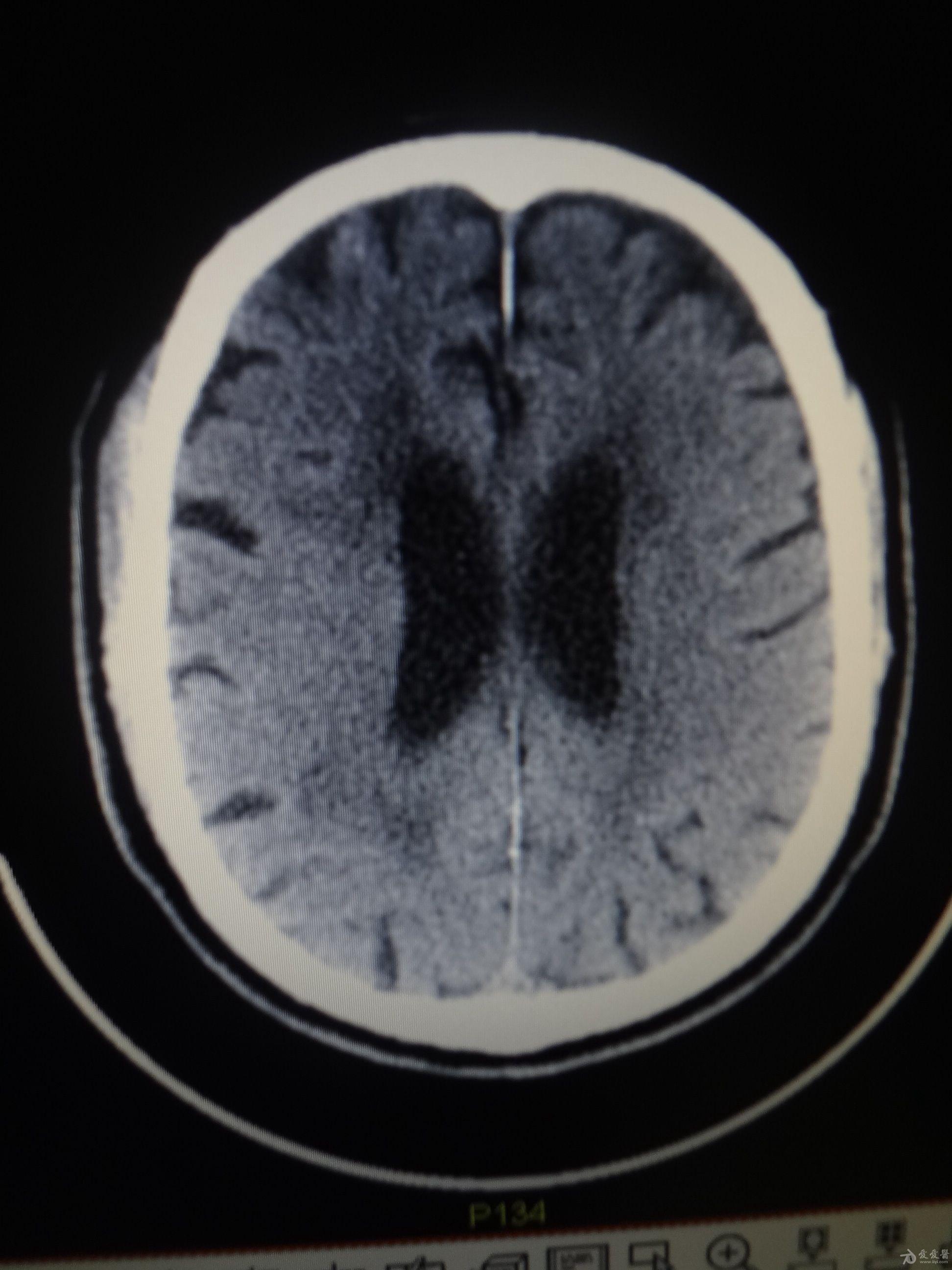 放射冠区脑梗死图片