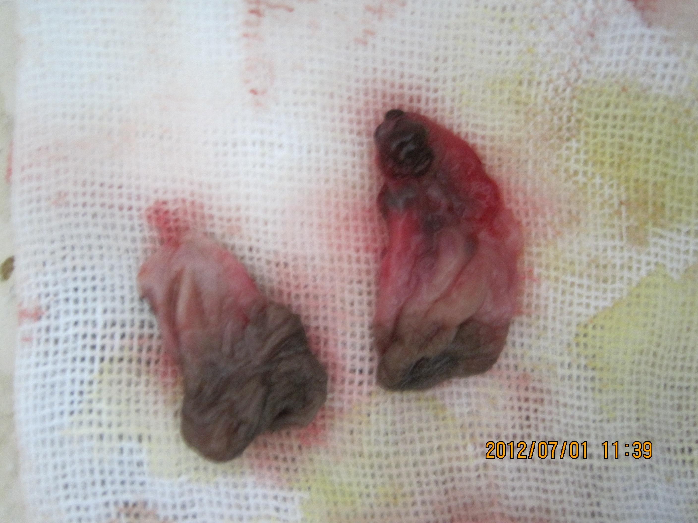 女性痔疮肉瘤图片图片