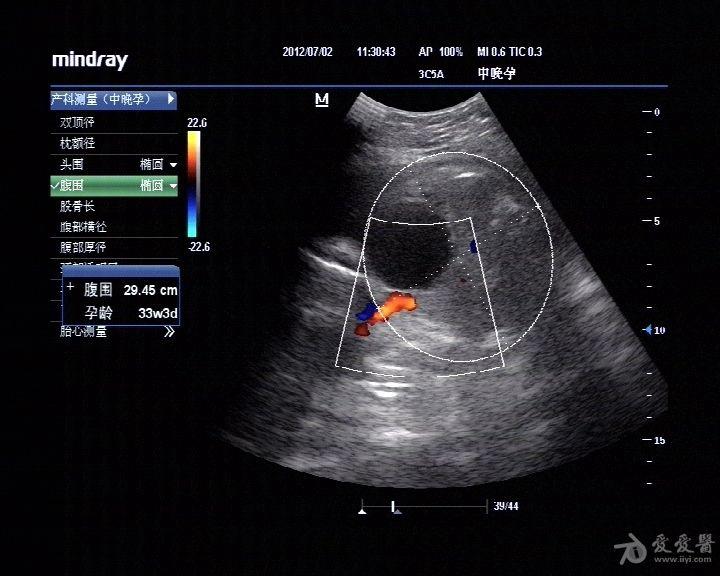 肠系膜囊肿超声图片图片