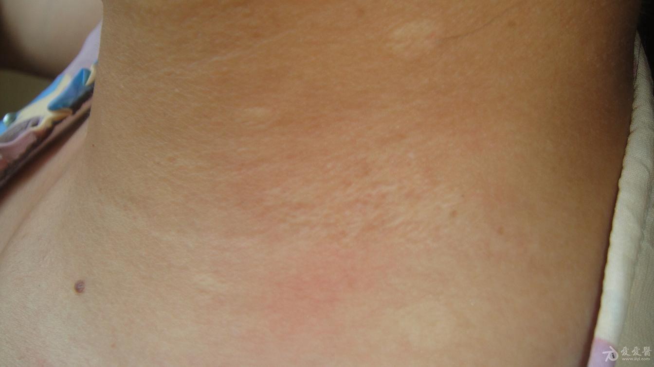 弹力纤维性假黄瘤