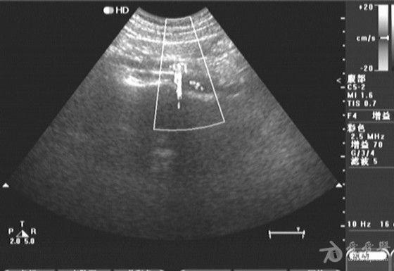 静脉石超声表现图片