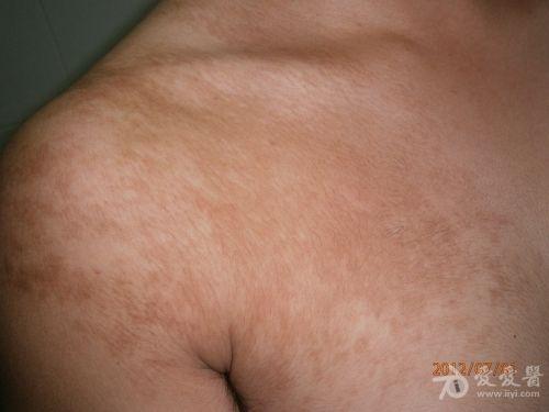 乳房周围有褐色斑点图片