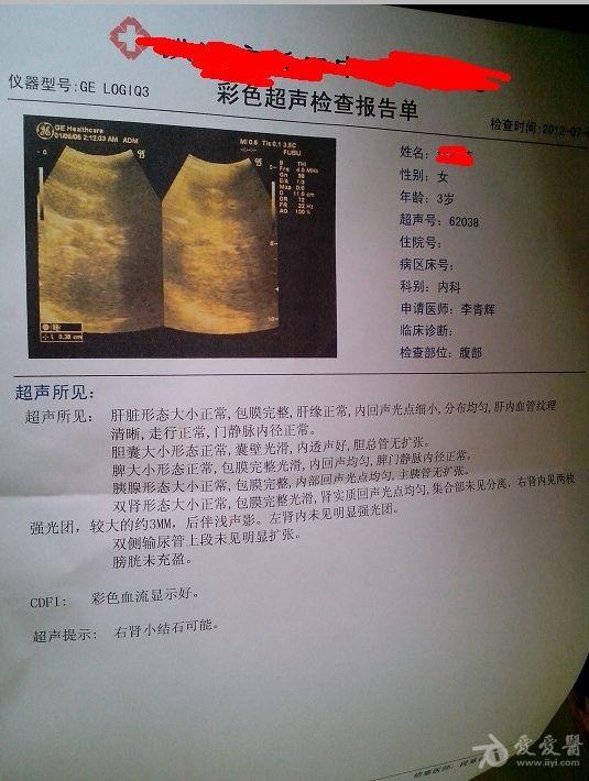 三岁小女孩肾结石