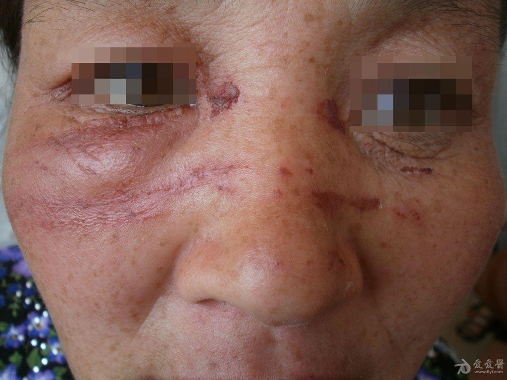 猜图病例36答案隐翅虫皮炎前5名回答对者已经加分