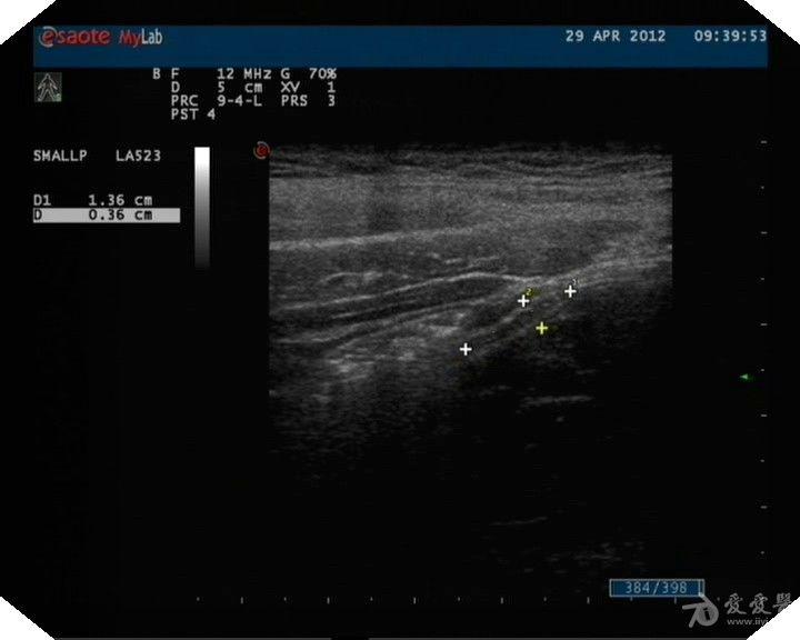 阑尾炎超声图图片