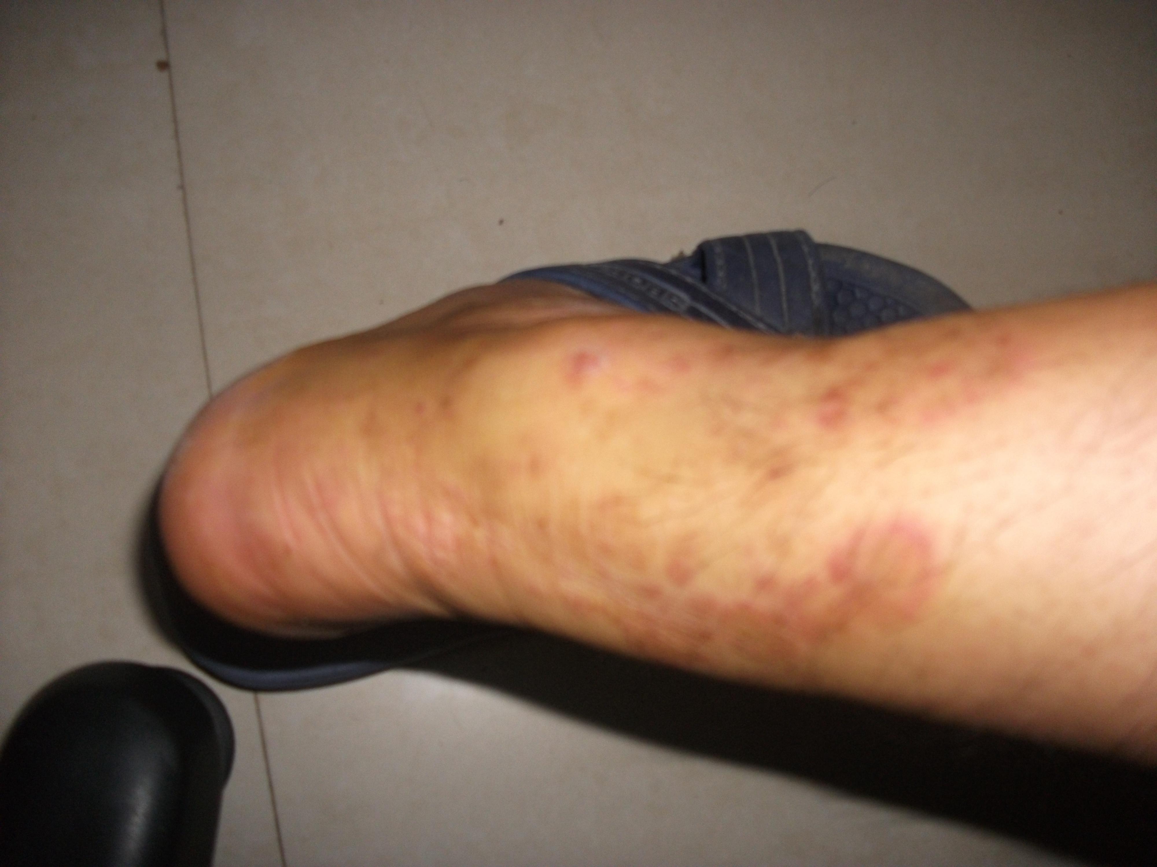 接触性皮炎治疗后 - 皮肤及性传播疾病讨论版 - 爱爱医医学论坛