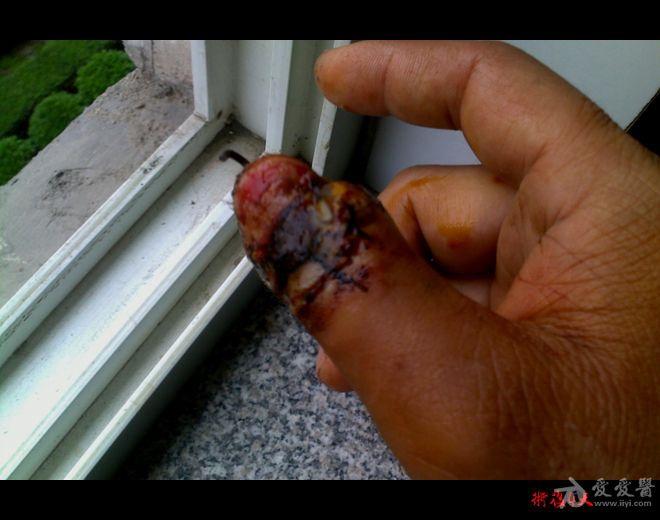 拇指摩托车链条碾压伤